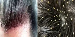 Điều trị và ngăn ngừa chấy ở đầu