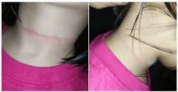 Hướng dẫn sơ cứu nạn nhân ngạt do treo cổ
