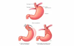 Điều trị đau ngực liên quan đến trào ngược dạ dày thực quản