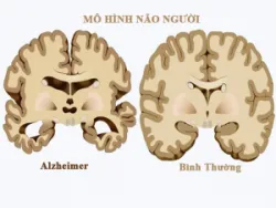Vai trò của chất béo chuỗi trung bình trong bệnh lý tim mạch và thần kinh