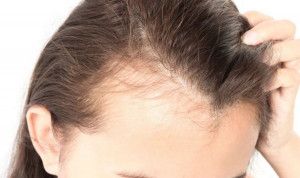 Thiếu hụt vitamin D có thể gây rụng tóc