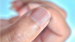 Các dấu hiệu móng tay cảnh báo bệnh ai cũng nên biết