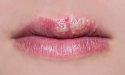 Phun môi bị nổi mụn nước xử lý thế nào hiệu quả nhất?