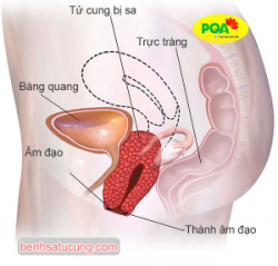 Hình ảnh sa tử cung sa xuống thành âm đạo