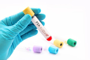 Mức PSA thay đổi như thế nào sau khi cắt tuyến tiền liệt?