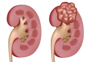 Ung Thư Biểu Mô Tế Bào Thận Thể Nhú