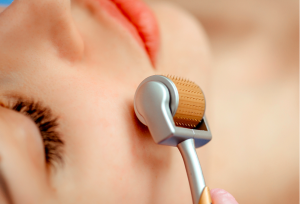 Cần chăm Sóc Da Sau Lăn Kim Thế Nào Cho Đúng?