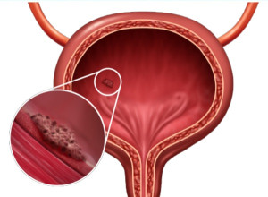 Ung thư bàng quang bề mặt có nghĩa là gì?
