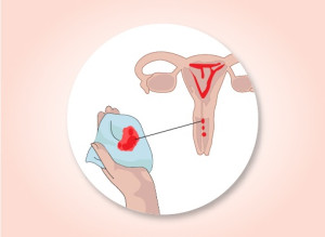 Các triệu chứng của ung thư tử cung sau mãn kinh