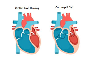 Các loại bệnh cơ tim và cách điều trị