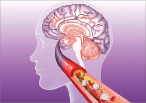 Đột quỵ do thuyên tắc là gì?