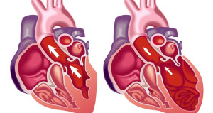 Sự khác biệt giữa suy tim trái và suy tim phải