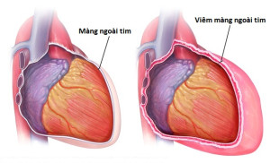 Viêm màng ngoài tim: Nguyên nhân, biến chứng và cach điều trị