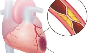 Nhận biết và quản lý suy tim tâm trương