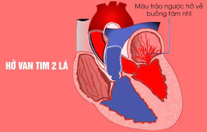Các dấu hiệu nhận biết hở van tim là gì?