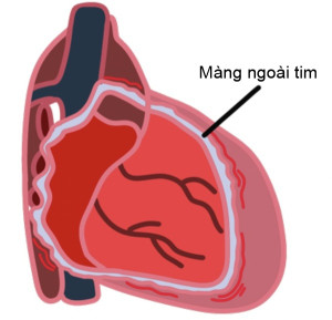 Viêm màng ngoài tim co thắt là gì?