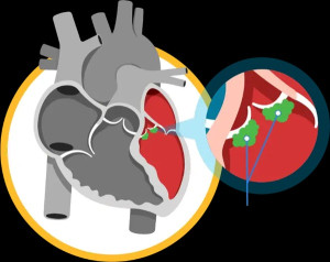 Viêm nội tâm mạc nhiễm trùng: Triệu chứng và phương pháp điều trị