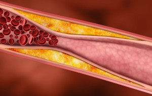 Triglyceride ảnh hưởng đến sức khỏe như thế nào?