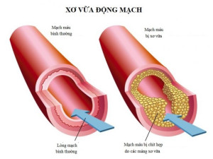 Xơ vữa động mạch có thể xảy ra mà không gây đau ngực không?