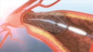 Stent có thể tồn tại bao lâu?