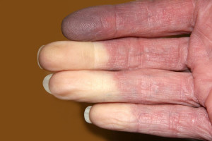 Tất cả những điều cần biết về hội chứng Raynaud