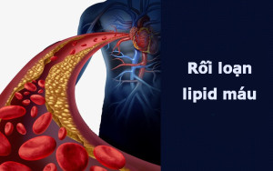 Những điều cần biết về rối loạn lipid máu