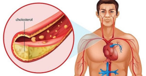Người trẻ có thể bị cholesterol cao không?