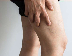 Những ai có nguy cơ bị huyết khối tĩnh mạch sâu?