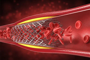 Thế nào là huyết khối trong stent?