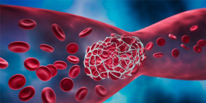 Huyết khối: Nguyên nhân, triệu chứng và phương pháp điều trị