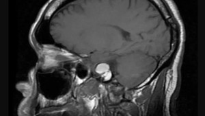 U hạt cholesterol: Nguyên nhân, triệu chứng và cách điều trị