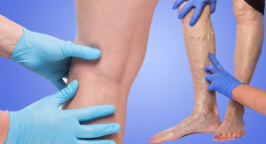 Tăng huyết áp tĩnh mạch điều trị bằng cách nào?