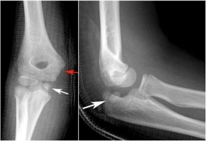 Trật khớp khuỷu tay điều trị bằng cách nào?