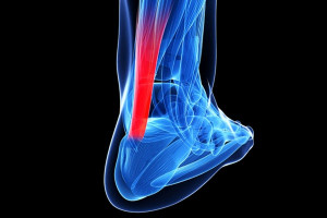 Viêm gân Achilles: Nguyên nhân và cách điều trị