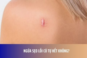 Ngứa Sẹo Lồi Có Tự Hết Không?