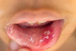 Nhiễm HPV ở miệng gây ra những vấn đề nào?