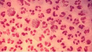 Nhiễm lậu cầu lan tỏa là gì?