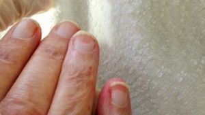 Móng tay, móng chân có gì thay đổi khi nhiễm HIV/AIDS?