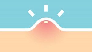 Tại sao lại bị mụn ở vùng kín?