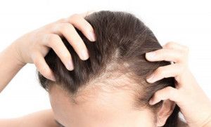 Cách khắc phục rụng tóc do hội chứng buồng trứng đa nang