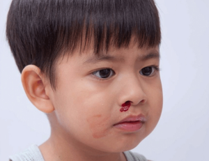 Trẻ bị chảy máu cam và cách xử lý