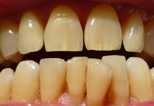 Khi nào nên tẩy trắng răng ố vàng?