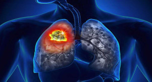 Đề phòng suy hô hấp nặng do bệnh phổi tắc nghẽn mạn tính