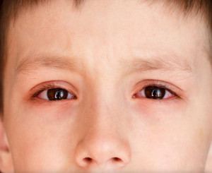 Tại sao nhiều trẻ em bị viêm kết mạc cấp (đau mắt đỏ)?