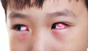 Cần làm gì để hạn chế lây nhiễm đau mắt đỏ?