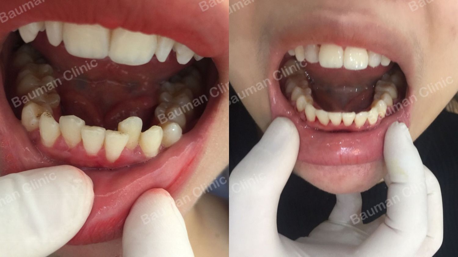 Ca niềng răng số 5064 - Nha khoa Bauman Clinic