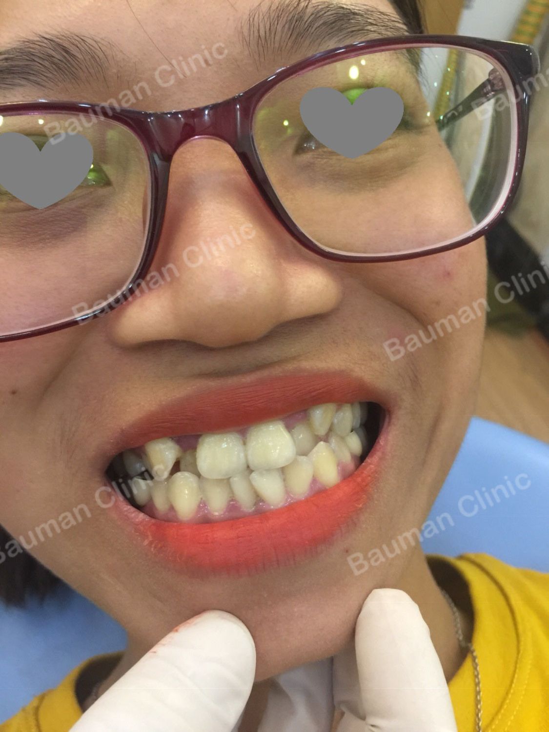 Ca niềng răng số 5065 - Nha khoa Bauman Clinic