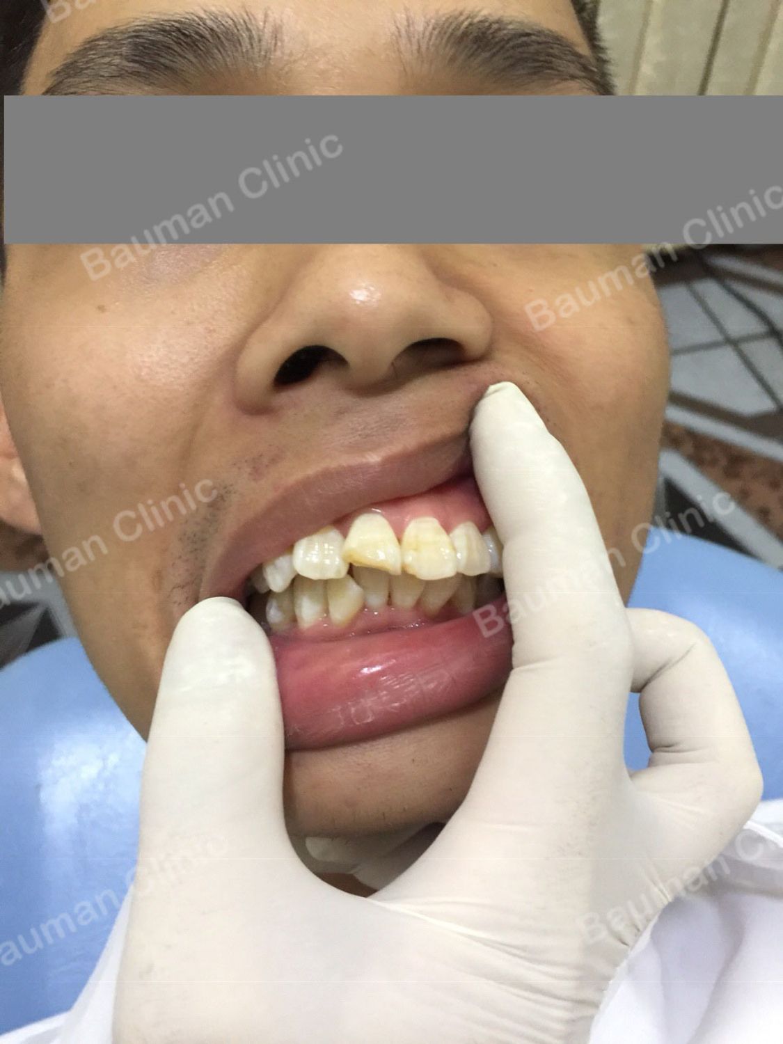 Ca niềng răng số 5025 - Nha khoa Bauman Clinic