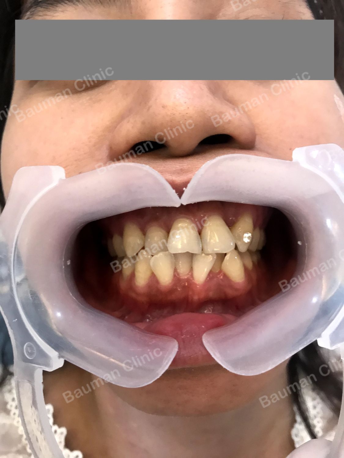 Ca niềng răng số 5019 - Nha khoa Bauman Clinic