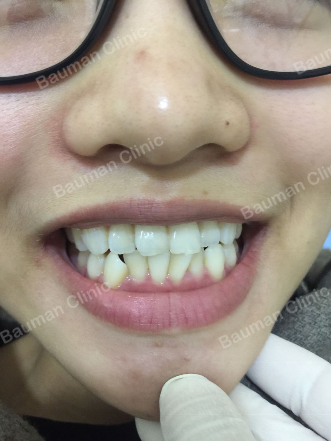 Ca niềng răng số 5029 - Nha khoa Bauman Clinic